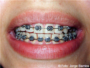 Brackets,Kinder,Graz,Zahnregulierungen,ästhetisch,Zahnärztinnen,Korrektur,Korrekturen,Behandlung,Regulierung,Hilfsmittel,sprechen,Zahntechnik,Kiefer,