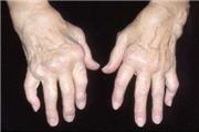 Rheumatologie, Schmerzen, Weichteilrheuma, www Rheuma, Arthritis, Arthritis Arthrose, Arthritis Behandlung