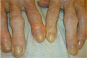 Arthritis bei, Arthritis Diagnose, Arthritis finger, Arthritis Symptome, Arthritis Therapie, durch Rheuma, Entzündung, Entzündungen