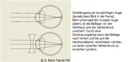 ,Kurz und Weitsichtigkeit,kurzsichtige,Kurzsichtigkeit,Kurzsichtigkeit Dioptrien,Kurzsichtigkeit Laser,Kurzsichtigkeit Operation,Laser 