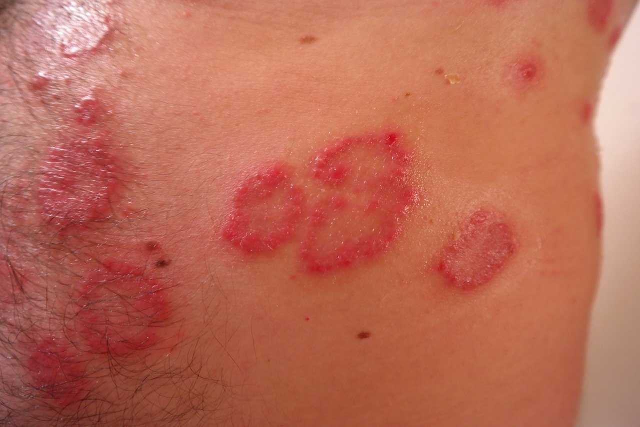 Die Haut ist entzündet und rot: das kann von Psoriasis vulgaris bis Neurode...