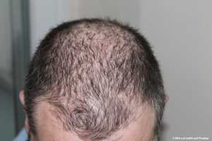 Haartransplantation FUE,Haarausfall,Männer,wissen,Vorbereitung,Ergebnisse,Pflege,Nachsorge,Erholung